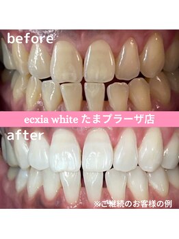 エクシアホワイトニング たまプラーザ店/ビフォーアフター