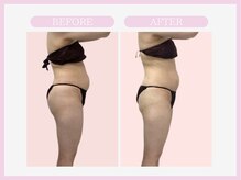 スリムライン 弘前店(The Slim Line)/before→after