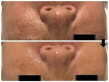 エフェクト 塚口店(effect)/Before After &nbsp;&nbsp;50代/3回目