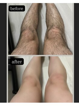 グロワール(gloire)の写真/脱毛シーズン到来☆今まで隠してた体毛や、剃っても剃っても終わりのない【生涯続く面倒な毛の処理は卒業】