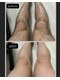 グロワール(gloire)の写真/脱毛シーズン到来☆今まで隠してた体毛や、剃っても剃っても終わりのない【生涯続く面倒な毛の処理は卒業】