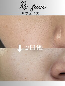コリー(Kolly)/リフェイス"部分コース"