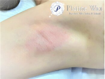 プラチナワックス(Platine Wax)/［わき］MIX脱毛［WAX＆FLASH］