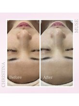 シャルムパリス(charme paris)/老けない肌に♪１回の施術変化