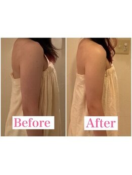 トータルビューティーサロン 凛/ブライダル二の腕引き締め