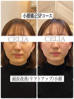 セリア(CELIA)/小顔矯正SPコース