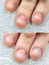 リファーレ(RIFARE)/【深爪矯正初回】before after