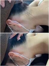 ミスターアンドミス脱毛専門店 難波店(Mr.&Ms.脱毛専門店)/えり足・うなじ脱毛