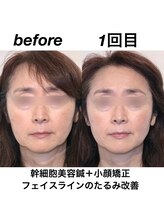 経堂鍼灸整体院/幹細胞美容鍼＋小顔矯正