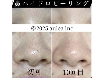 アウレア 辻堂(aulea)/毛穴ハイドロピーリング