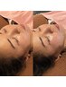 NEW【目元集中】美容鍼+目元しっかりケア《クマ・たるみ・疲れ目に》