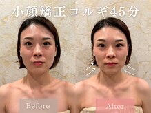 ドレッサー 福岡香椎店(DRESSER)/【症例】小顔コルギ1回の結果
