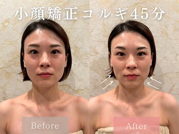 ドレッサー 福岡香椎店(DRESSER)/【症例】小顔コルギ1回の結果