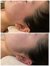 ルノン(LUNON)/お顔の産毛、もみあげWax脱毛