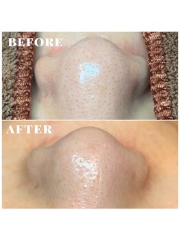 シェソワ(Chez soi)/毛穴エクストラクション