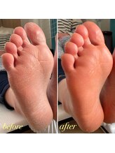 ダイヤモンドボディ/フット角質ごっそりオフ