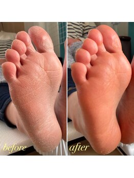 フット角質ごっそりオフ