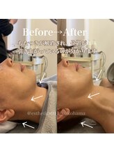 エステティックス ナインワンワン 横浜(Esthetics911) /リフトアップ手技で肩首コリ解消