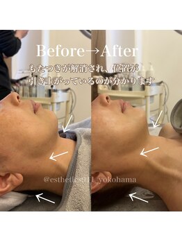 エステティックス ナインワンワン 横浜(Esthetics911) /リフトアップ手技で肩首コリ解消