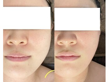 シェリートーキョー 成田店(Cherie Tokyo)/リフトアップフェイシャル