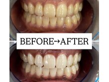 ホワイトニングサロン 宝塚/Before&After美白ホワイトニング