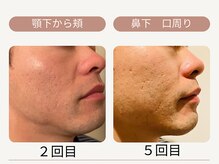 サロンリアン(salon Lien)/◇メンズ脱毛ひげ◇