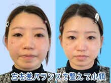 ナチュラルビューティーフェイス 横浜(NBF)/むくみ・丸顔 / 20代/造顔横浜
