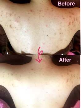 チャーム(Charm)/背中のくすみ、毛穴、ニキビケア