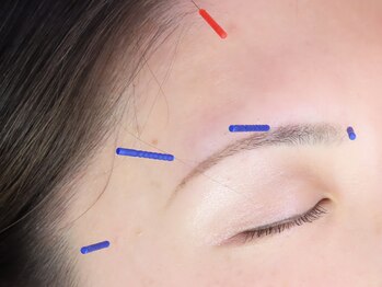 飯田橋駅前鍼灸整骨院/眼精疲労【飯田橋/鍼灸】