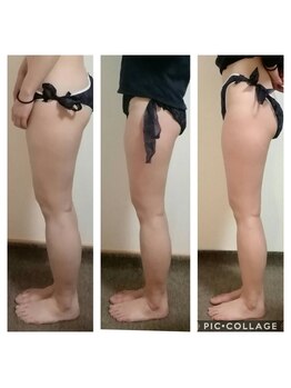 ビューティールーム 優美/痩身コース　ビフォーアフター