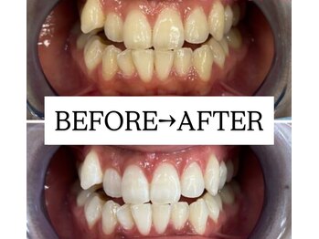ホワイトニングサロン 宝塚/Before&After美白ホワイトニング