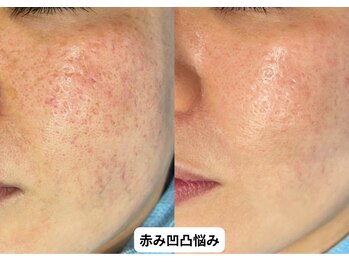 リメイク 銀座(REMAKE)/幹細胞ゴールドピーリング