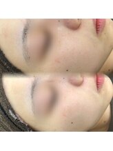 プラシア 広島駅(Purasia.)/水光肌　フェイシャルケア