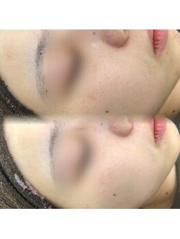 プラシア 広島駅(Purasia.)/水光肌 フェイシャルケア