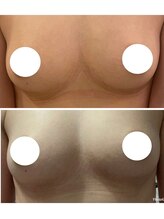 ルミエール(Lumiere)/【倉敷市】バストアップ施術事例