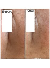 ポノーラ(Ponola)/ゾンビマスク