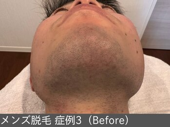 オアシスラグーン(OASIS LAGOON)/メンズ脱毛(症例3 before)