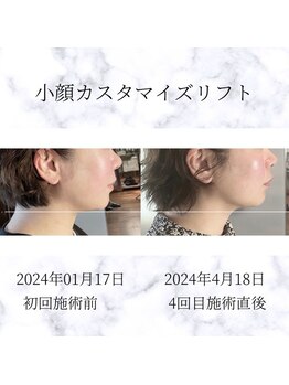 サロン ド メデューズ 札幌店(Salon de meduse)の写真/フェイスラインのもたつきOFF！キュッと引き締まった、すっきりとした印象の小顔へ導きます◎
