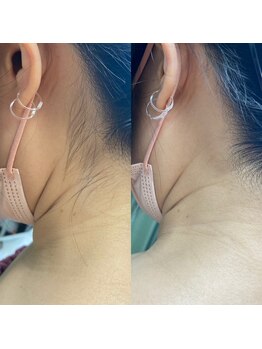 プライベートサロン結/うなじのお手入れ