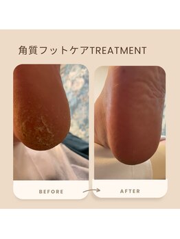 ベル(Belle)/角質フットケア