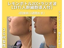 イーラボ 池袋店(e-LABO)/レモンボトル+ラジオ波Lift