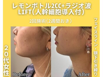 イーラボ 池袋店(e-LABO)/レモンボトル+ラジオ波Lift