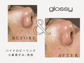 グロッシー(glossy)/【症例】小鼻皮脂詰まり黒ずみ