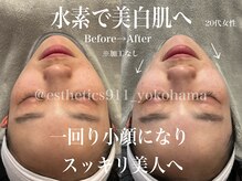 エステティックス ナインワンワン 横浜(Esthetics911) /美白＋シミケアもお任せ！！