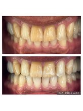 ホワイトニング美白ラボ 筑西店(ホワイトニング美白LAB)/