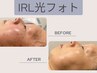 《フェイシャル》IPL光フォトでシミにアプローチエイジングケア