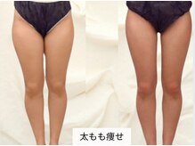 トレゾール(tresor)/【痩身】引き締め（-６cm）