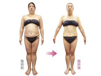 フジグラン安芸ベルミーランド/痩身before→after