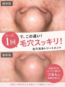 グラシア(gracia)の写真/スッピンでも自信の持てるツルスベ肌に！当店人気NO.1★【毛穴汚れ・黒ずみ撃退コース￥7,300→￥3,630】