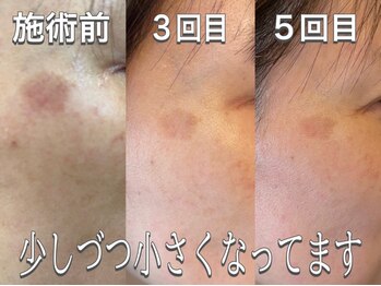 エヴェリーナ(Eveliiina)/50代女性シミケア/フェイシャル